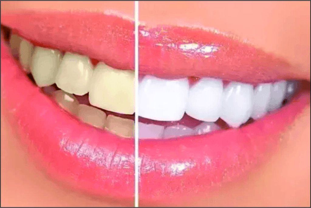 Bleaching