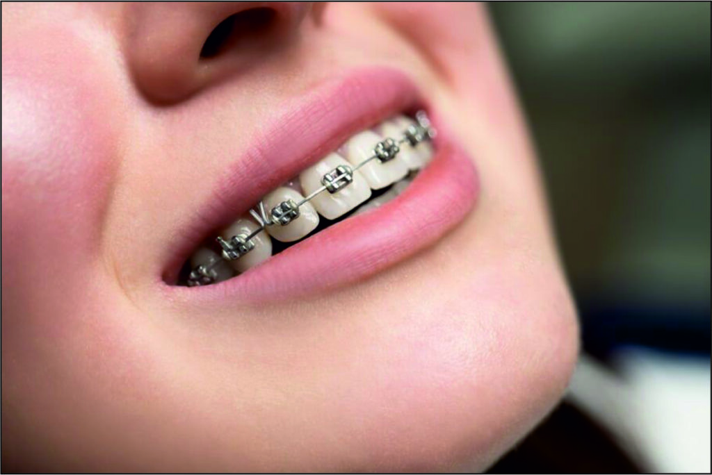 Braces