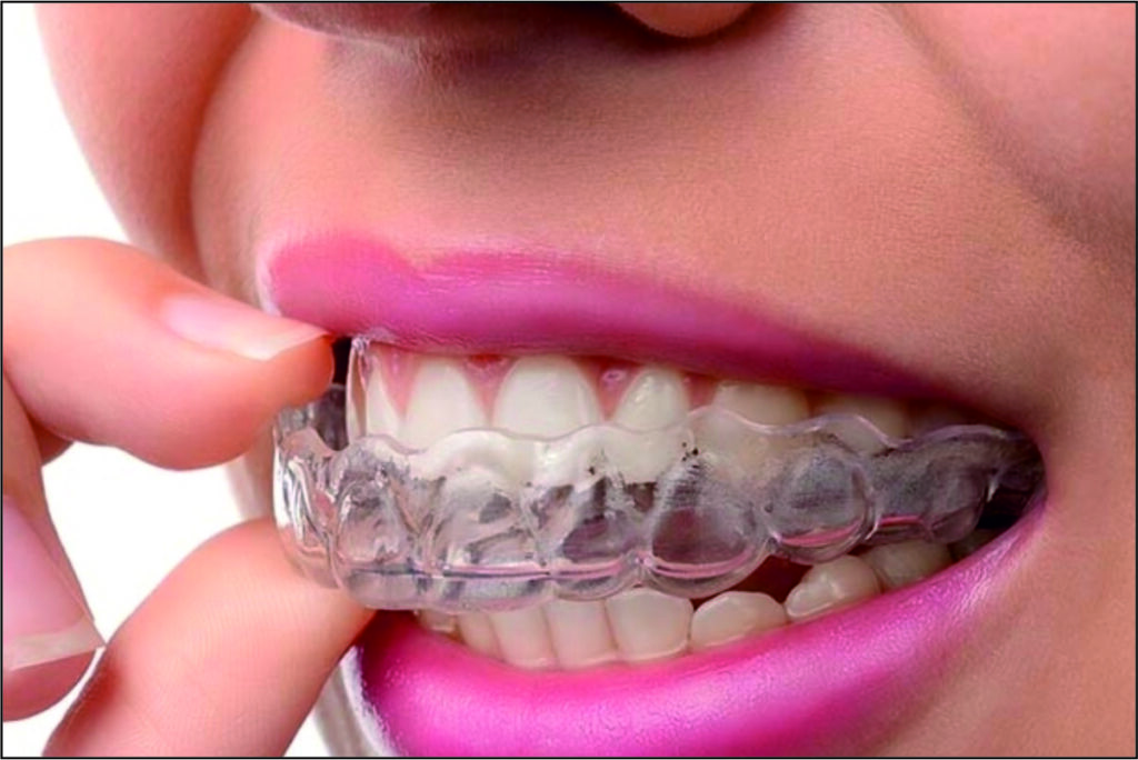 Clear Aligners Invisible Braces