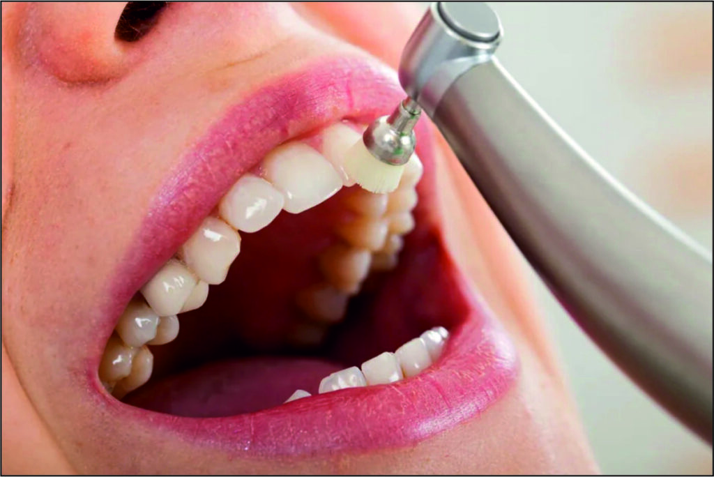 Fluoride Treatment
