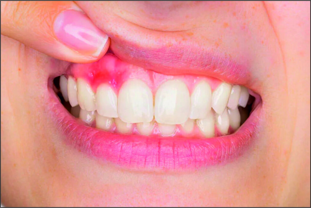 Gum Disease