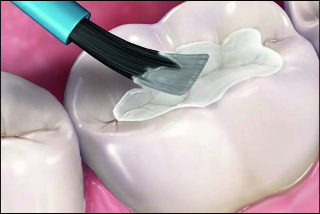 Sealants
