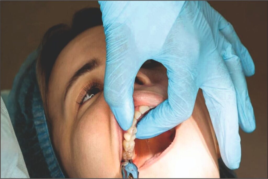 Extraction & Surgical Procedures