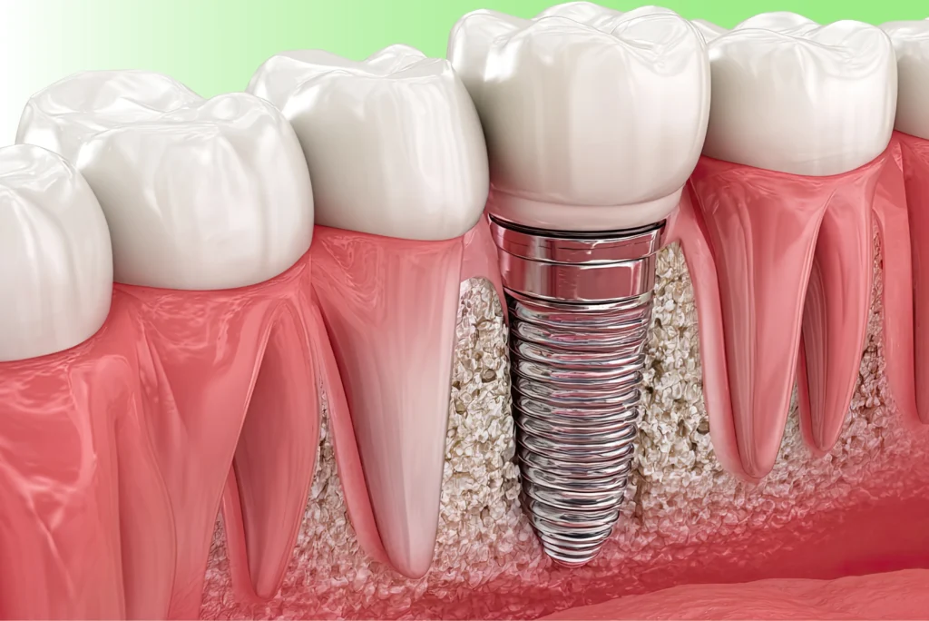 Infected Dental Implant