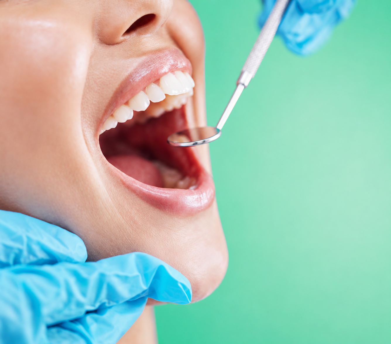 Dental Cleaning in Chandigarh Dental Cleaning in Chandigarh