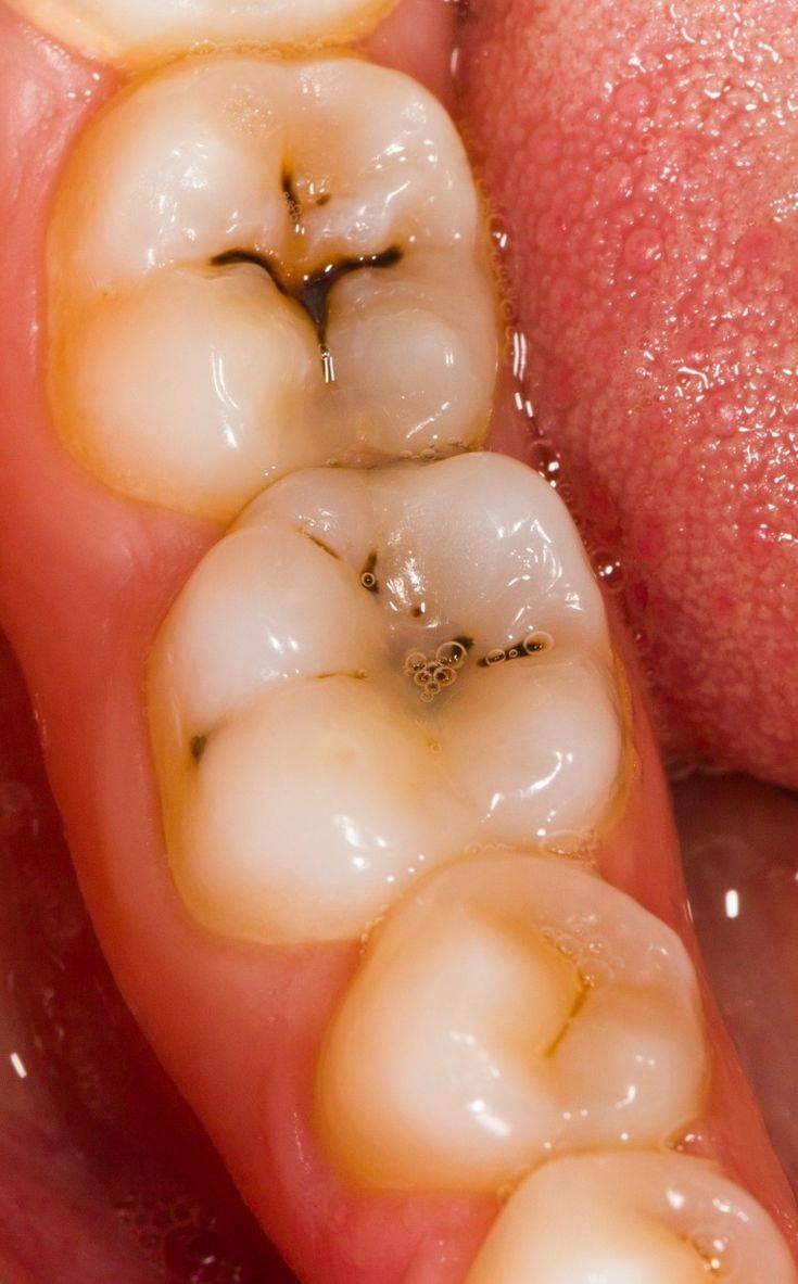 Cavity Treatment in Chandigarh Cavity Treatment in Chandigarh