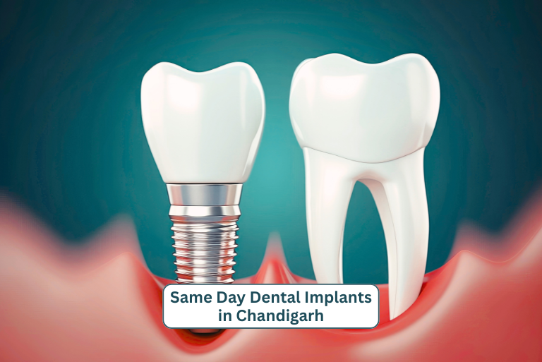 Same Day Dental Implants in Chandigarh