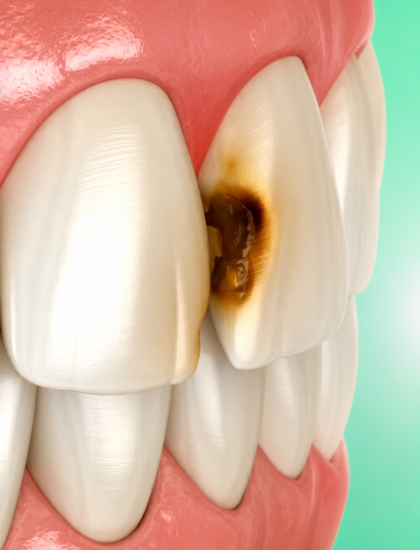 Cavity Treatment in Chandigarh Cavity Treatment in Chandigarh