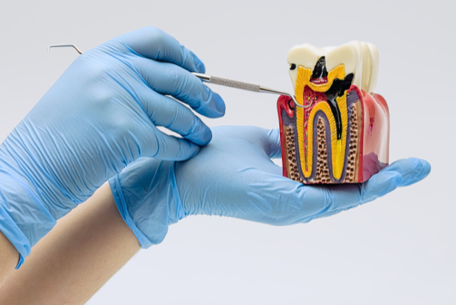 Root Canal