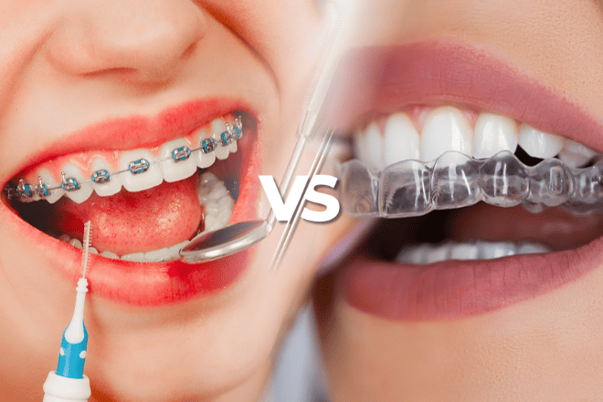 Invisalign vs Braces
