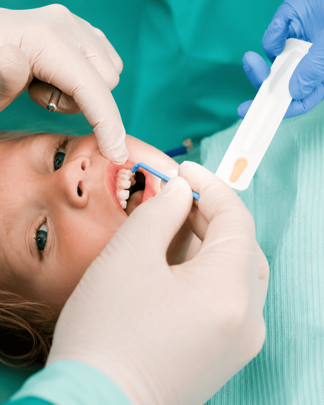 Fluoride Treatment in Chandigarh Fluoride Treatment in Chandigarh