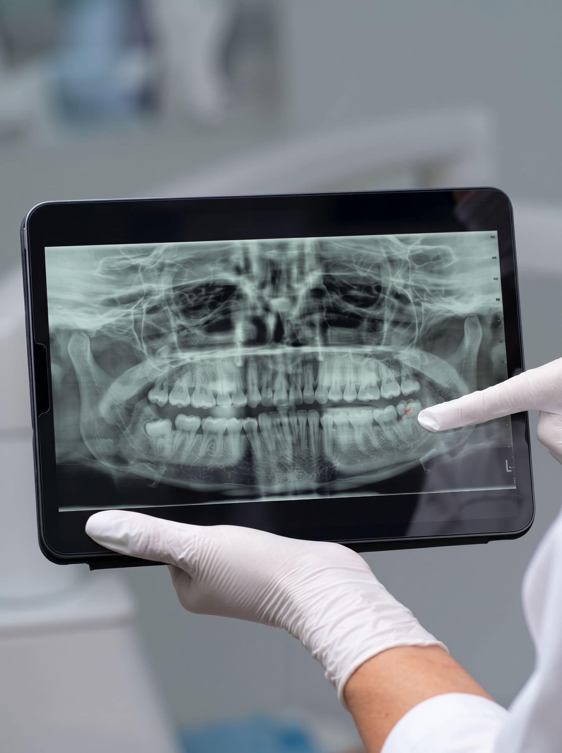 Dental X-Ray in Chandigarh (1)