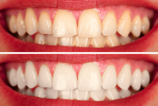 Teeth Whitening Treatment