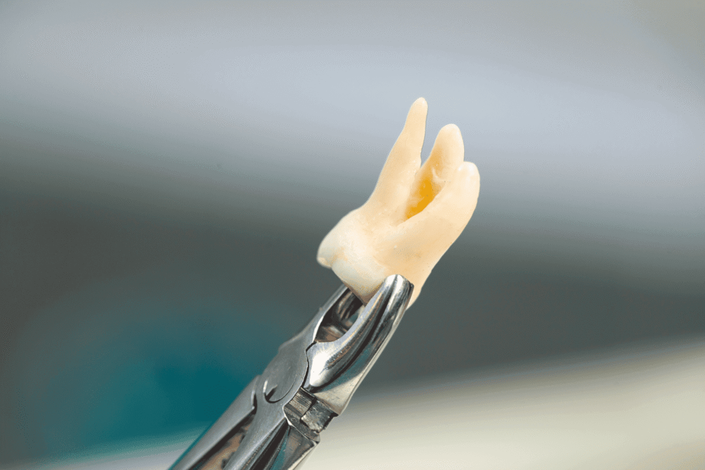 Wisdom Tooth Removal